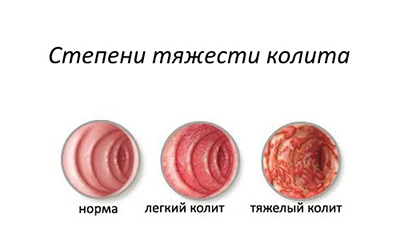 картинка степени колита