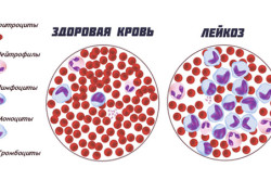 Здоровая кровь и лейкоз