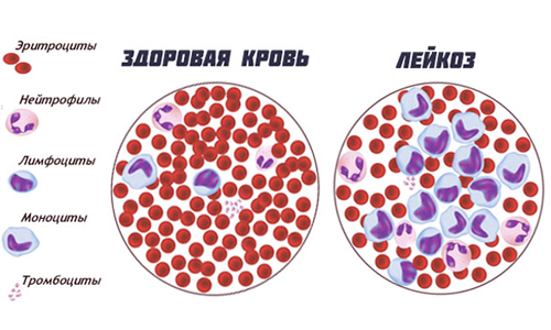 Здоровая кровь и лейкоз Здоровая кровь и лейкоз