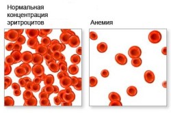 Состав крови при фолиеводефицитной анемии