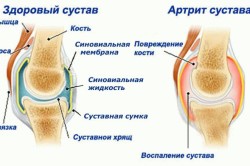 Схема артрита