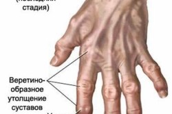 Изменения в кистях при артрите