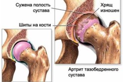 Артрит тазобедренных суставов
