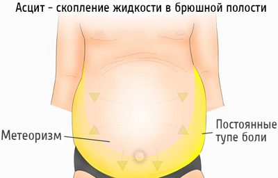 Проявление асцита