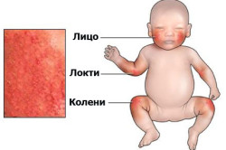 Атопический дерматит у детей