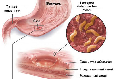 Бактерия helicobacter pilory