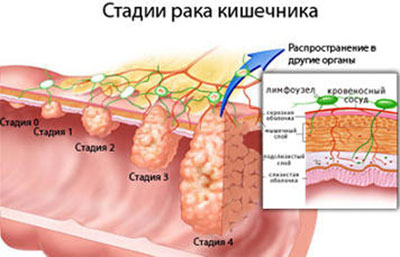 Стадии рака кишечн