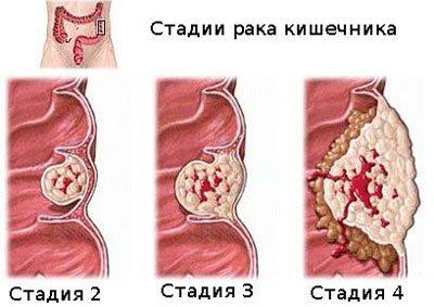 Стадии рака
