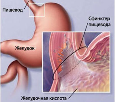 Механизм изжоги