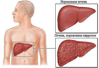 Печень с циррозом