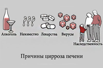 Причины цирроза