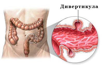 Дивертикул толстой кишки