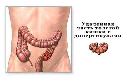 Удаленная часть толстой кишки