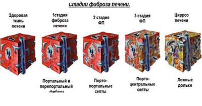 Стадии фиброза печени