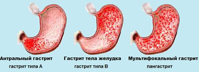 Виды гастрита