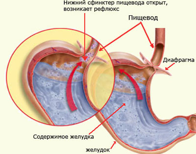 Возникновение изжоги