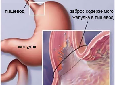 Проявление рефлюкса