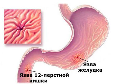 Язвы жкт