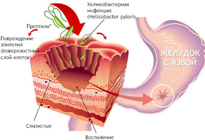 Картинка язвы желудка