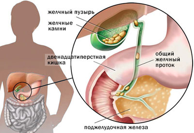 Камни при холецистите