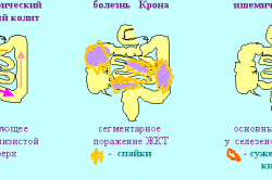 Отличительные особенности колитов