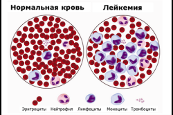 Кровь при лейкозе