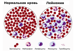Состав крови при лейкозе