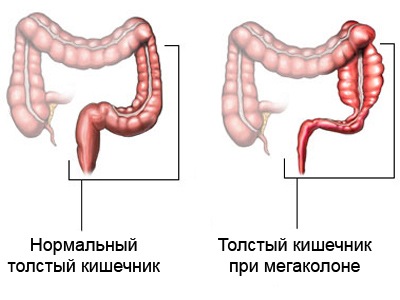 Толстый кишечник при мегаколоне