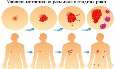 Распространение метастаз