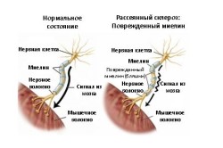 Распад миелиновых структур при рассеянном склерозе