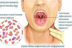 Основные клинические проявления мононуклеоза