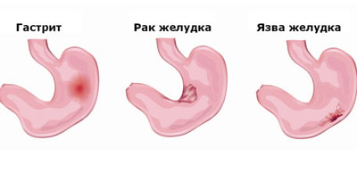 Болезни желудка
