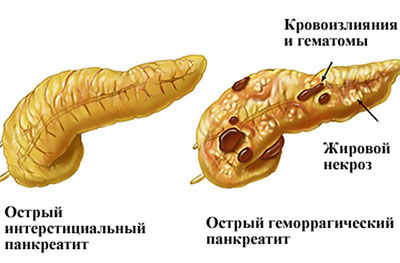 Признаки острого панкреатита