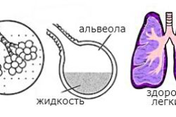 Схема отека легких