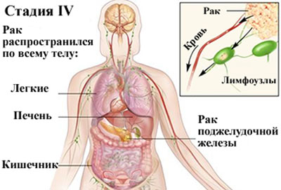 Рак четвертой стадии