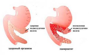 здоровая и воспаленная поджелудочная железа