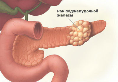 Рак поджелудочной железы
