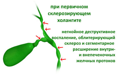 Следствие холангита