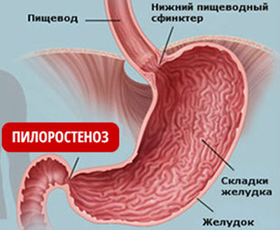 Проявление стеноза желудка