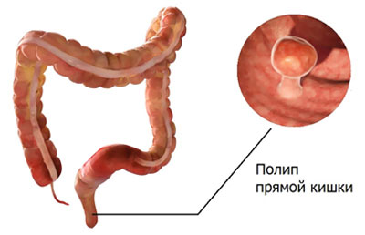 Новообразование в прямой кишке