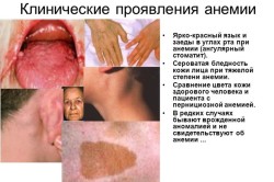 Клинические проявления анемии