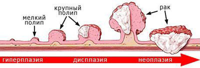 Развитие полипов
