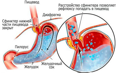 Попадание желчи в желудок