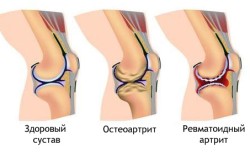 Виды ревматоидного артрита Виды ревматоидного артрита