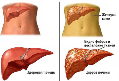 Здоровая и больная печень