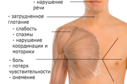 Симптомы рассеянного склероза
