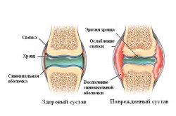 Синовиальная жидкость при ревматоидном артрите