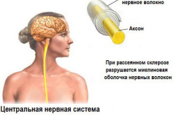 Разрушение миелиновой оболочки при рассеянном склерозе