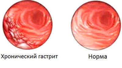 Слизистая при гастрите