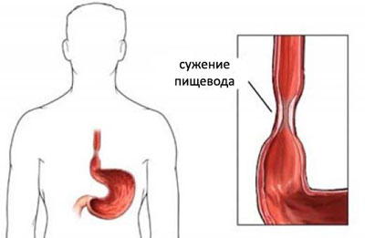 Сужение пищевода